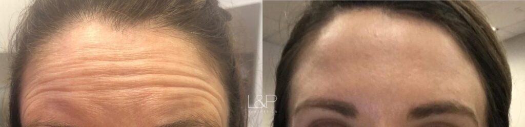 Botox Cosmetic before and after treatment