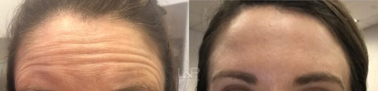 Botox Cosmetic before and after treatment