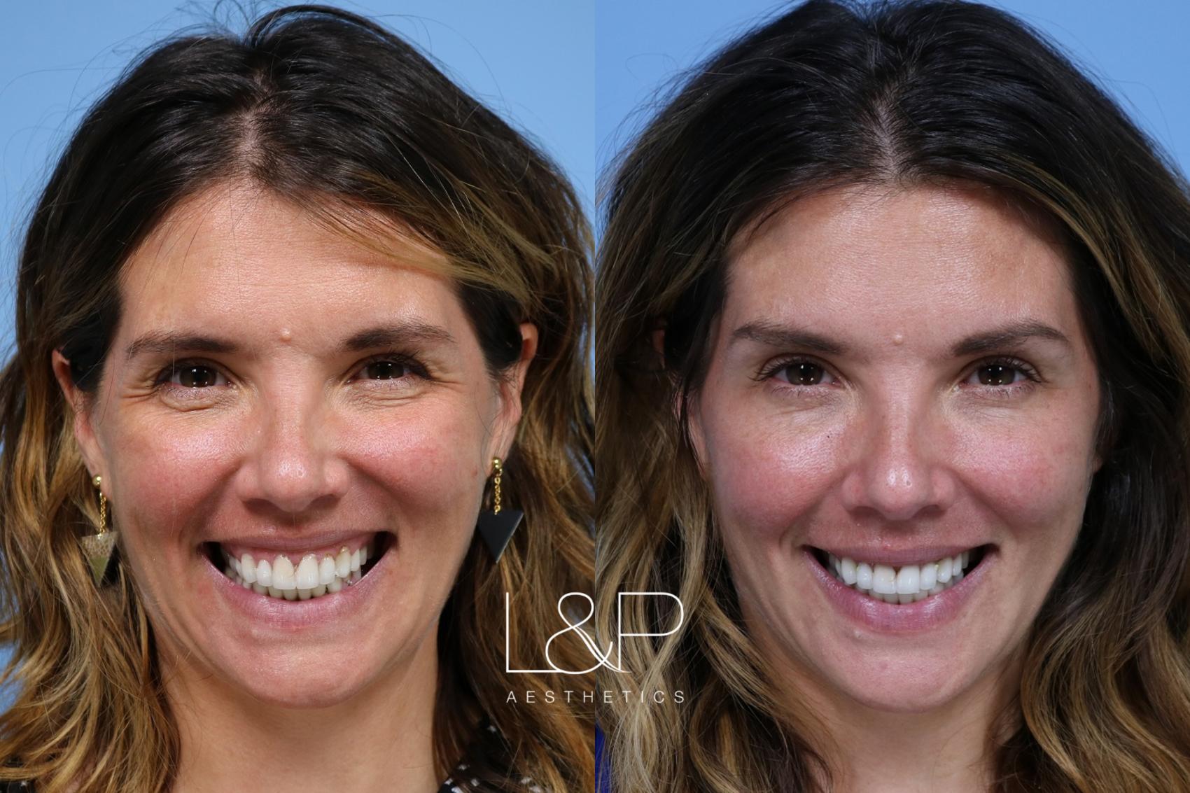 Botox Cosmetic before and after treatment