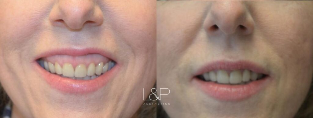 Botox Cosmetic before and after treatment