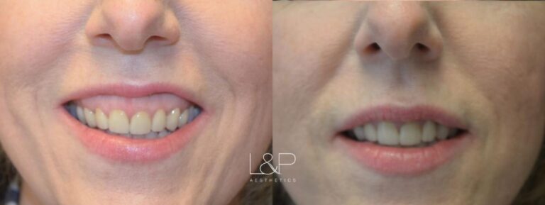 Botox Cosmetic before and after treatment