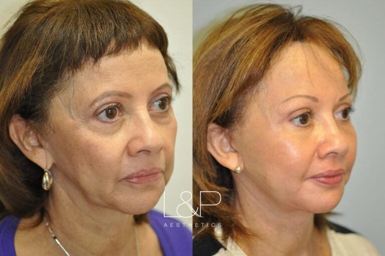 Brow Lift before and after treatment in Palo Alto, California