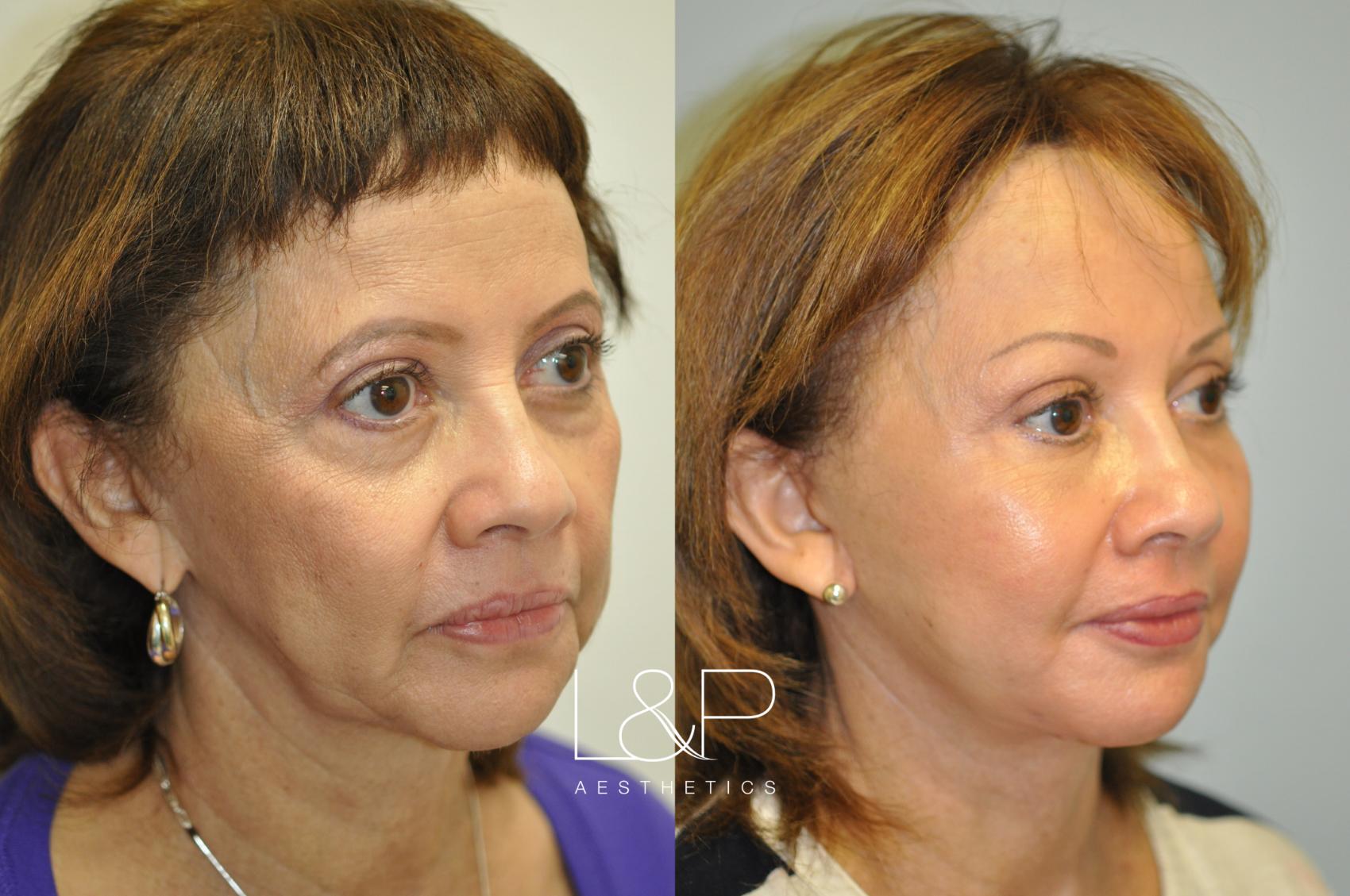 Brow Lift before and after treatment in Palo Alto, California