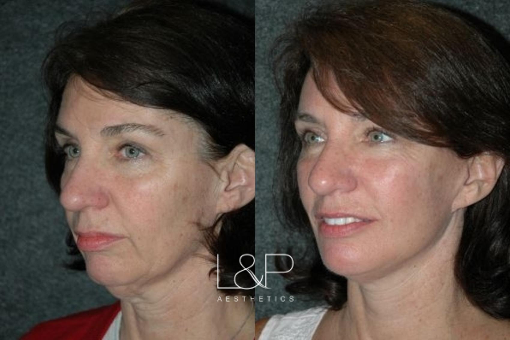 Chin Augmentation before and after treatment