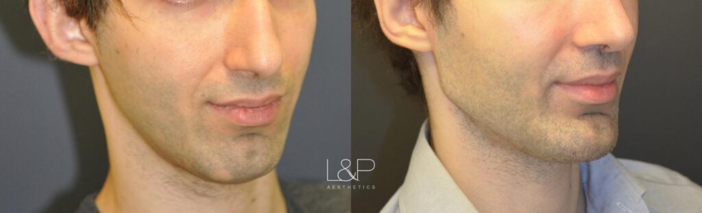 Chin Augmentation before and after treatment
