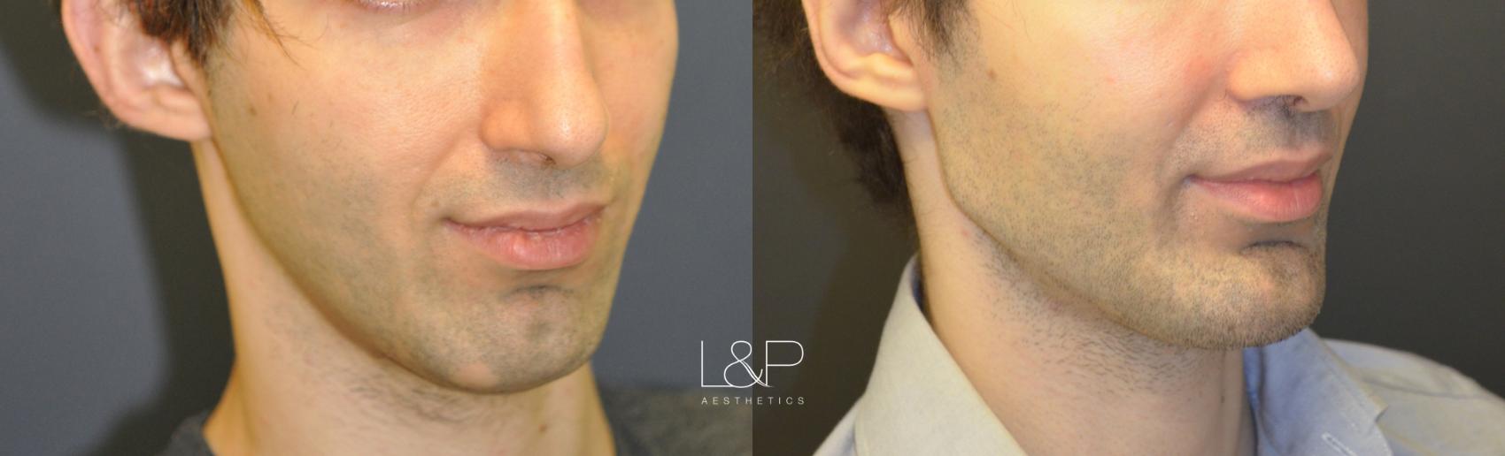 Chin Augmentation before and after treatment