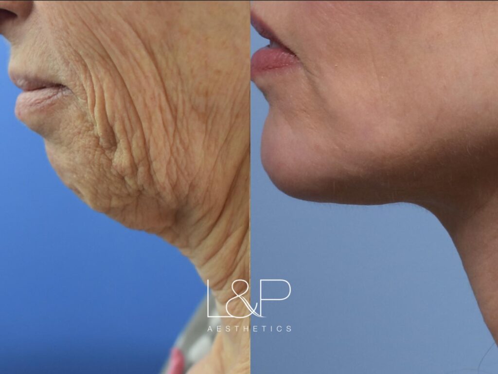 Facelift Neck Lift before and after treatment in Los Gatos, CA