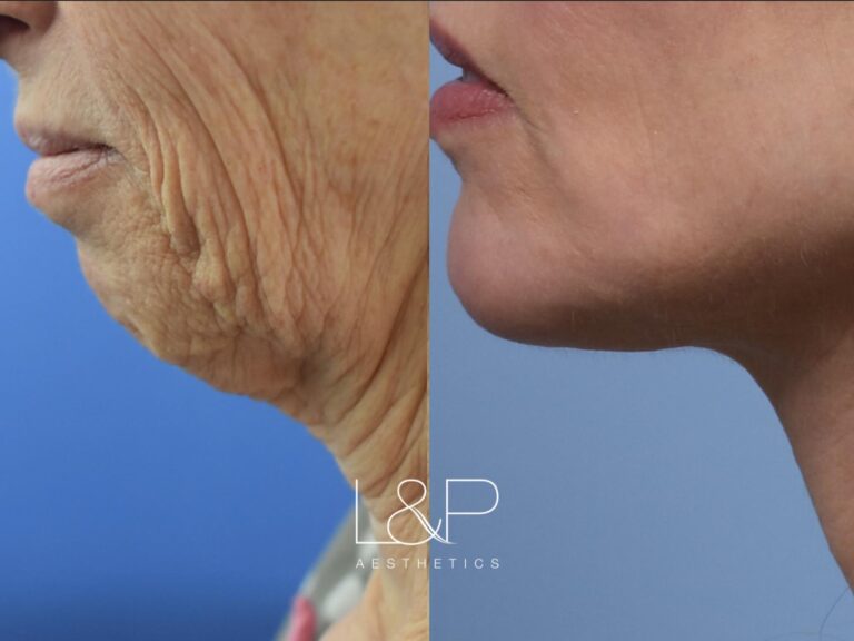 Facelift Neck Lift before and after treatment in Los Gatos, CA