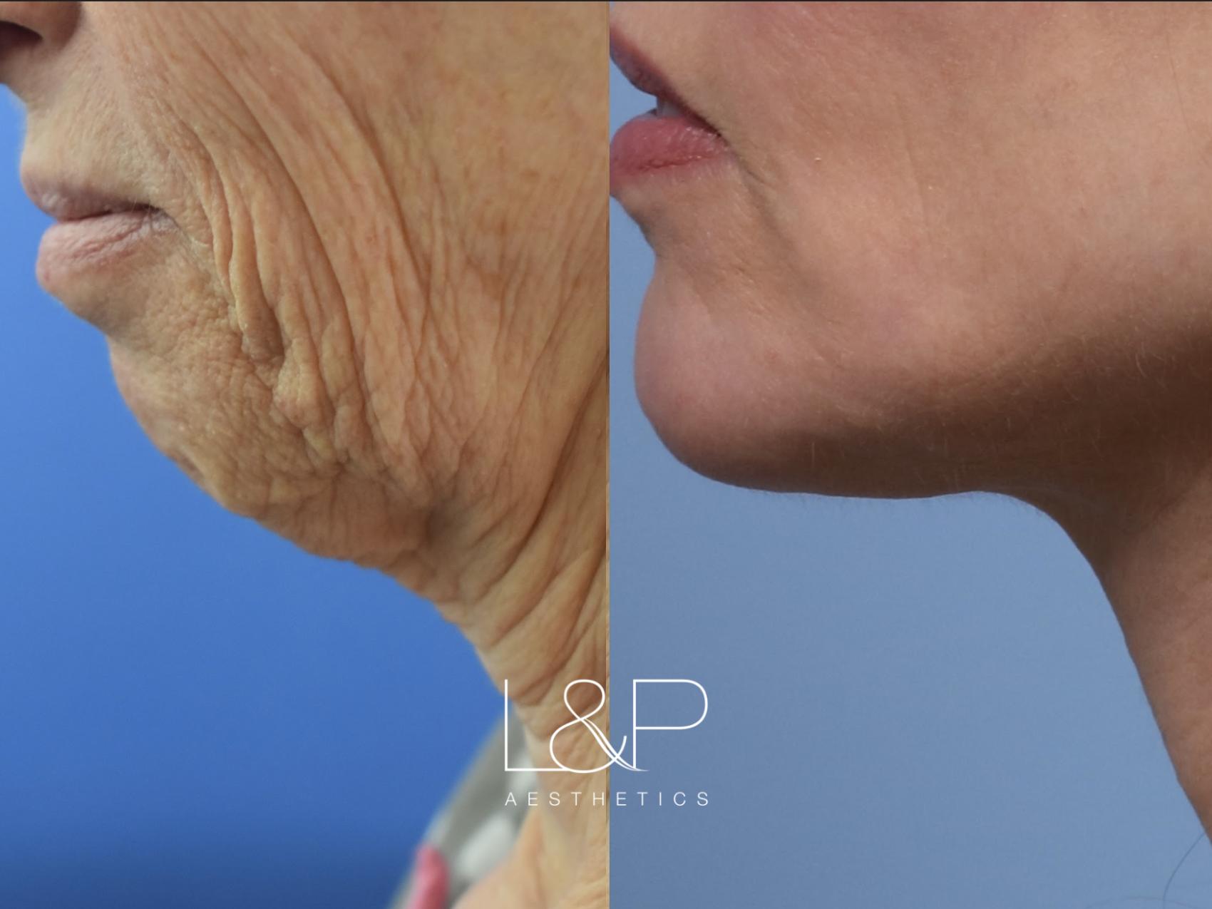 Facelift Neck Lift before and after treatment in Los Gatos, CA