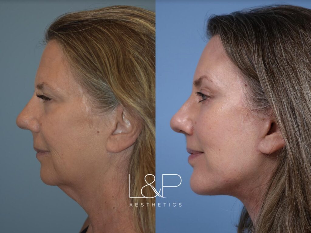 Facelift Neck Lift before and after treatment in the Bay Area