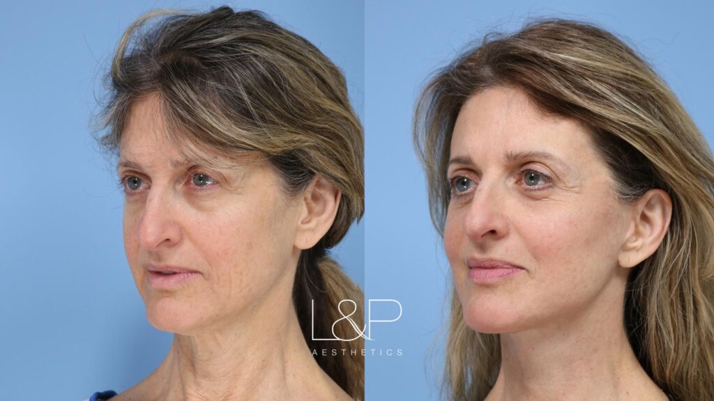 Facelift Neck Lift before and after treatment in the Bay Area