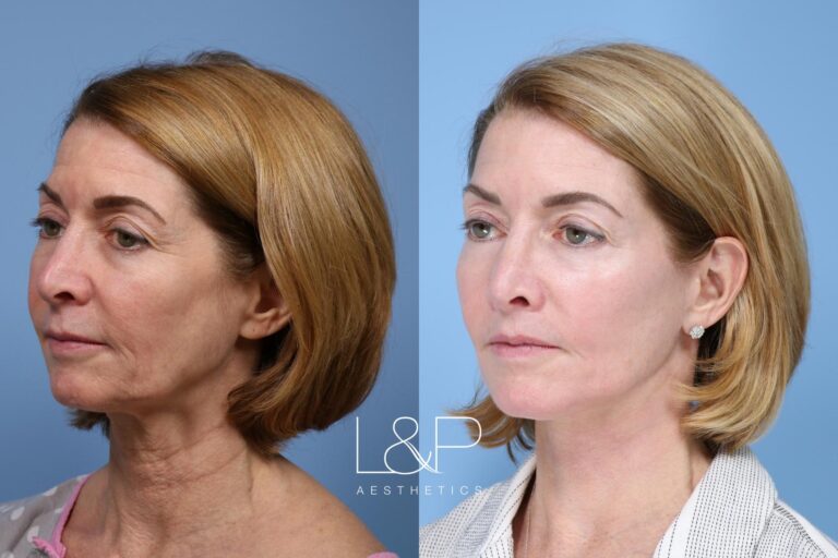 Facelift Neck Lift before and after treatment