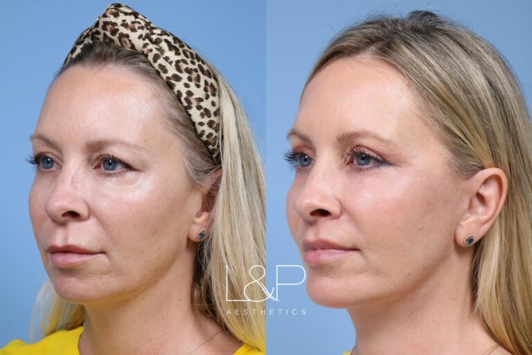 Facelift Neck Lift before and after treatment in Palo Alto, California