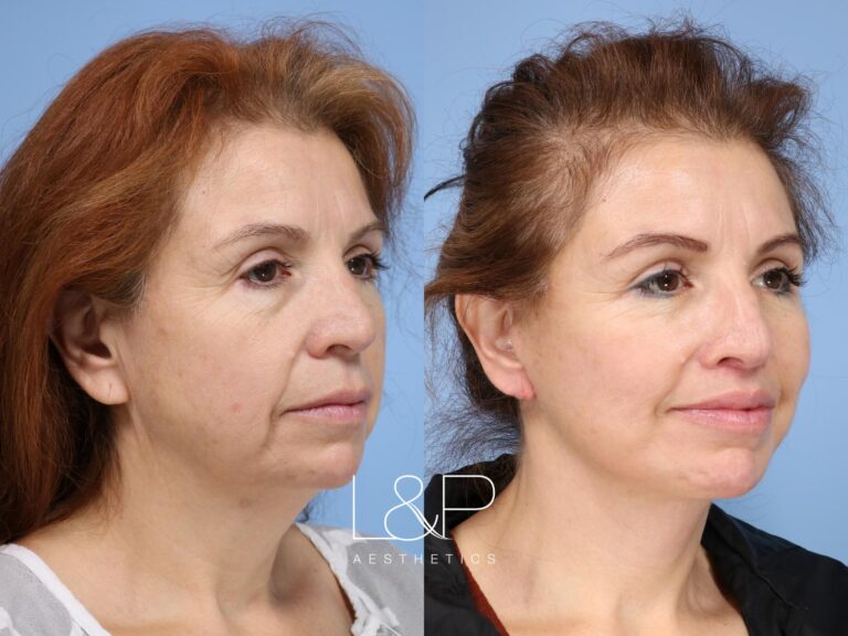 Facelift Neck Lift before and after treatment in Palo Alto, California