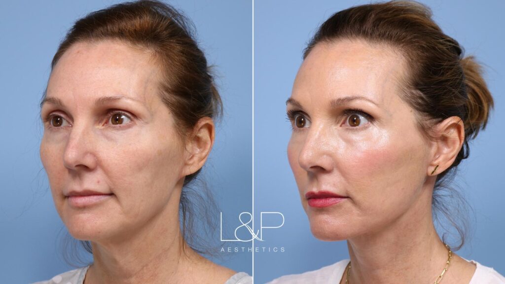 Facelift Neck Lift before and after treatment in Los Gatos, CA
