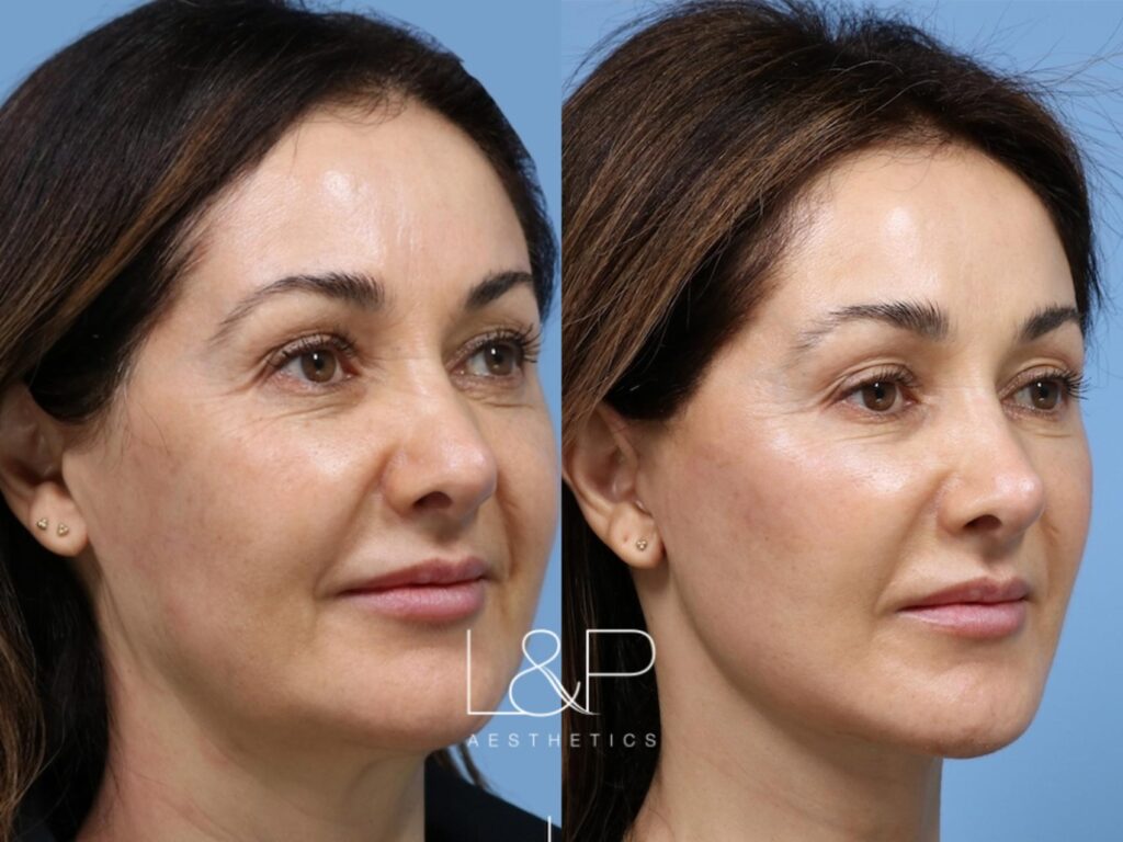 Facelift Neck Lift before and after treatment