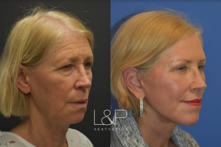 Facelift Neck Lift before and after treatment in Los Gatos, CA