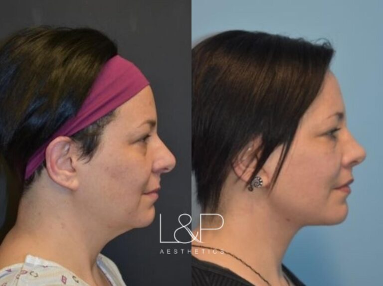 Rhinoplasty & Facelift Neck Lift before and after treatment in the Bay Area