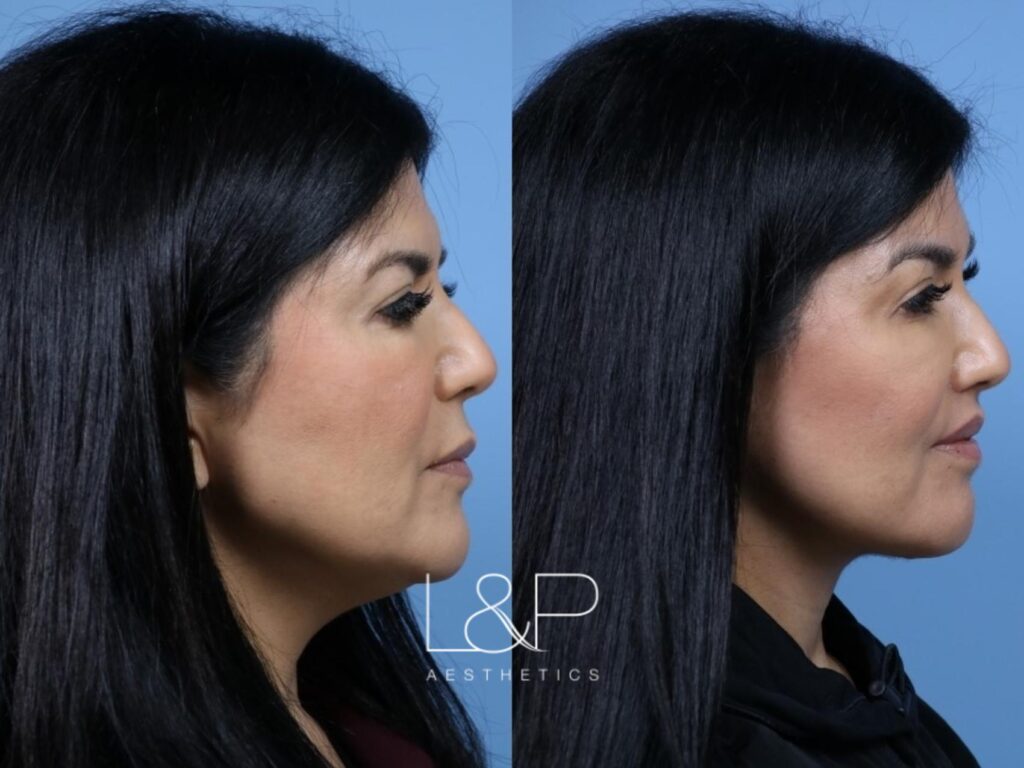 Facelift Neck Lift before and after treatment