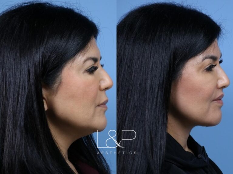 Facelift Neck Lift before and after treatment