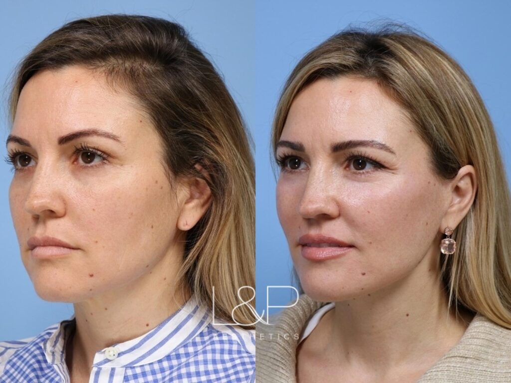 Facelift Neck Lift before and after treatment