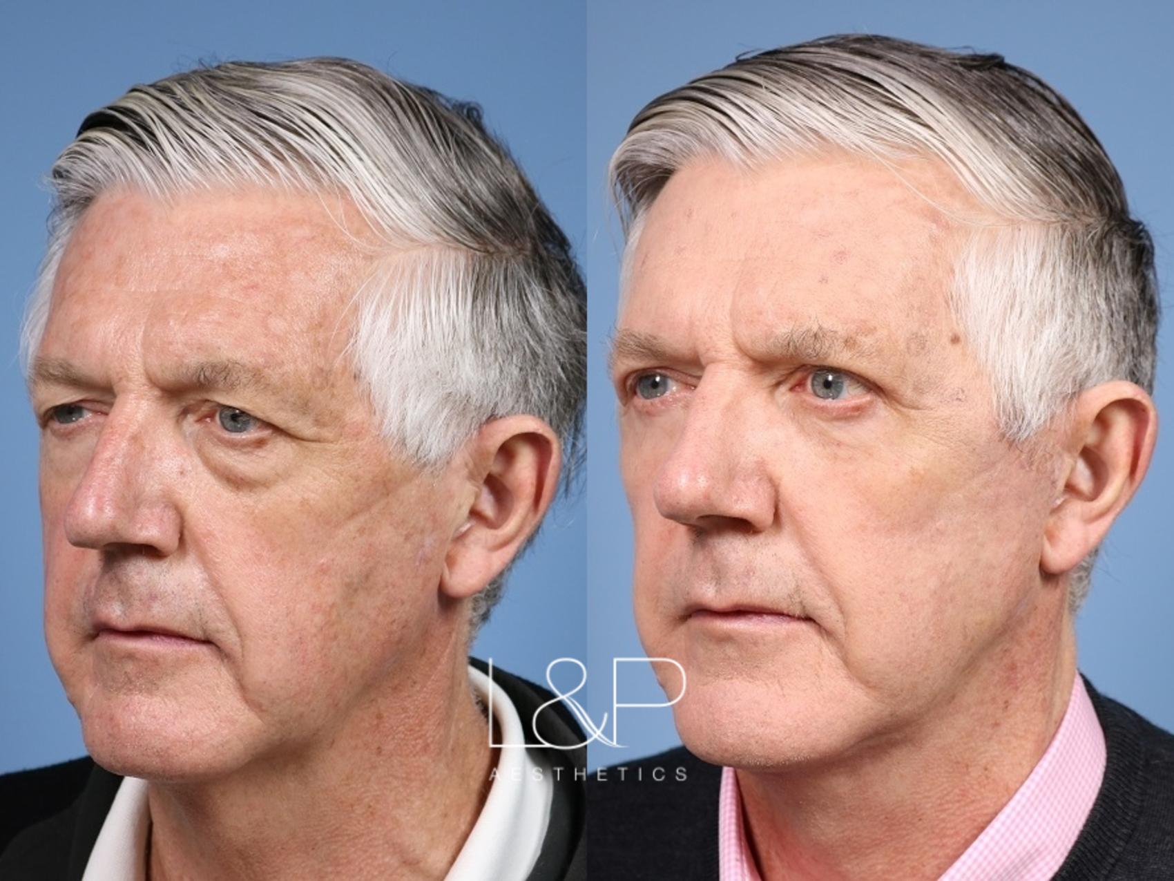 Facelift Neck Lift before and after treatment