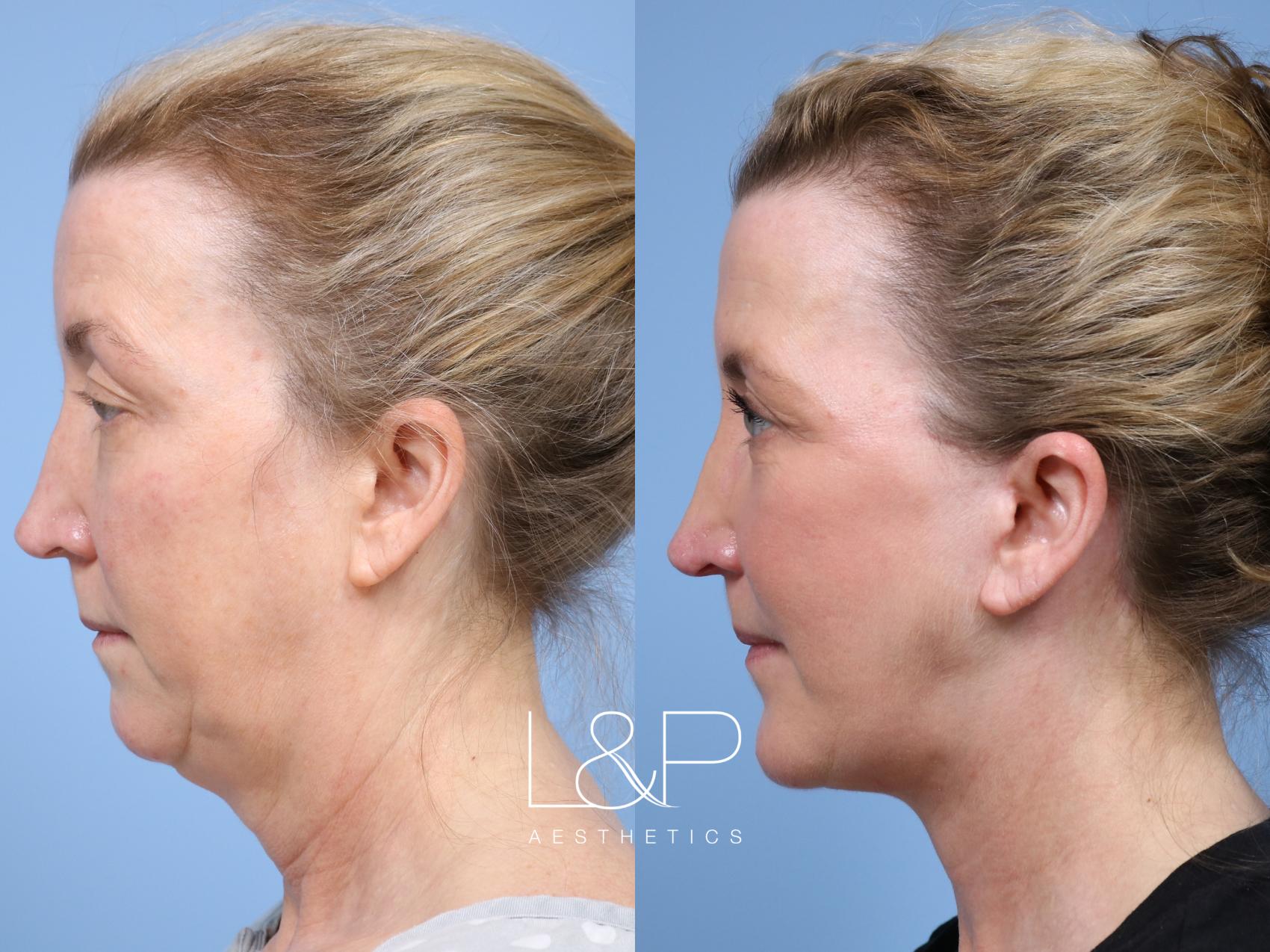 Facelift Neck Lift before and after treatment