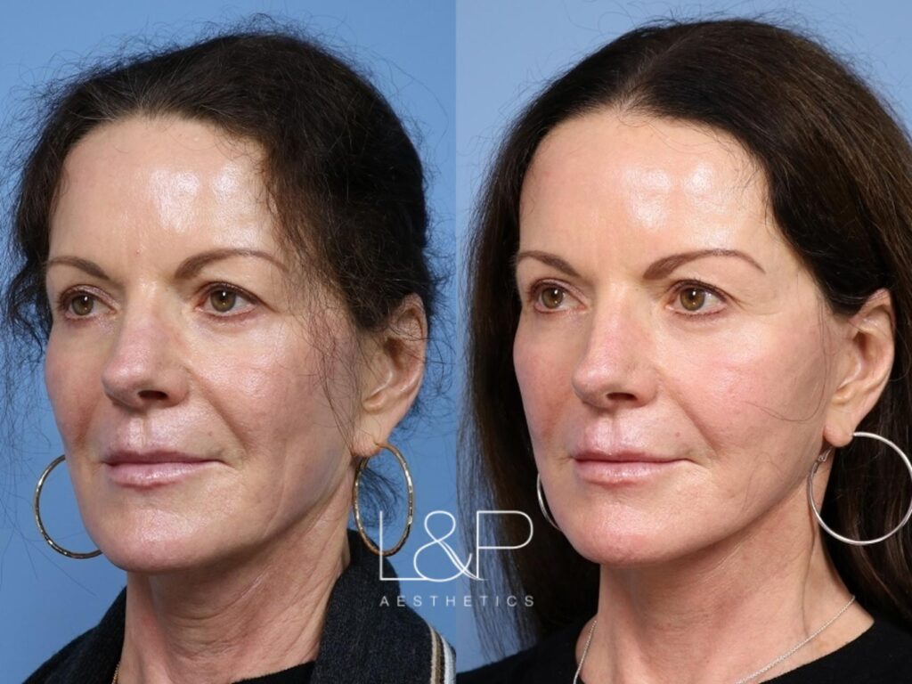 Facelift Neck Lift before and after treatment - Facelift Palo Alto