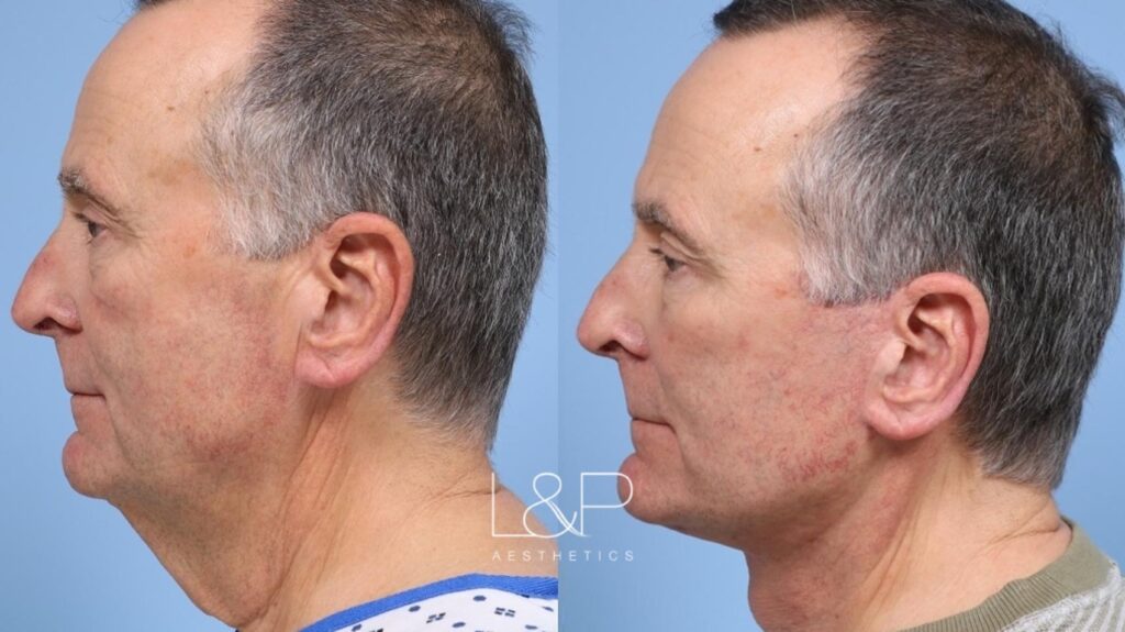 Facelift Neck Lift before and after treatment