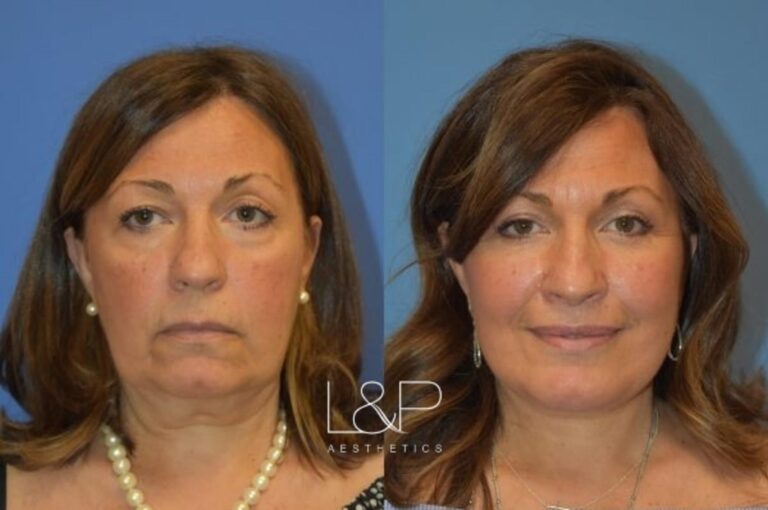 Facelift Neck Lift before and after treatment in Palo Alto, CA