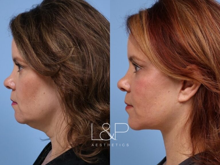 Facelift Neck Lift before and after treatment