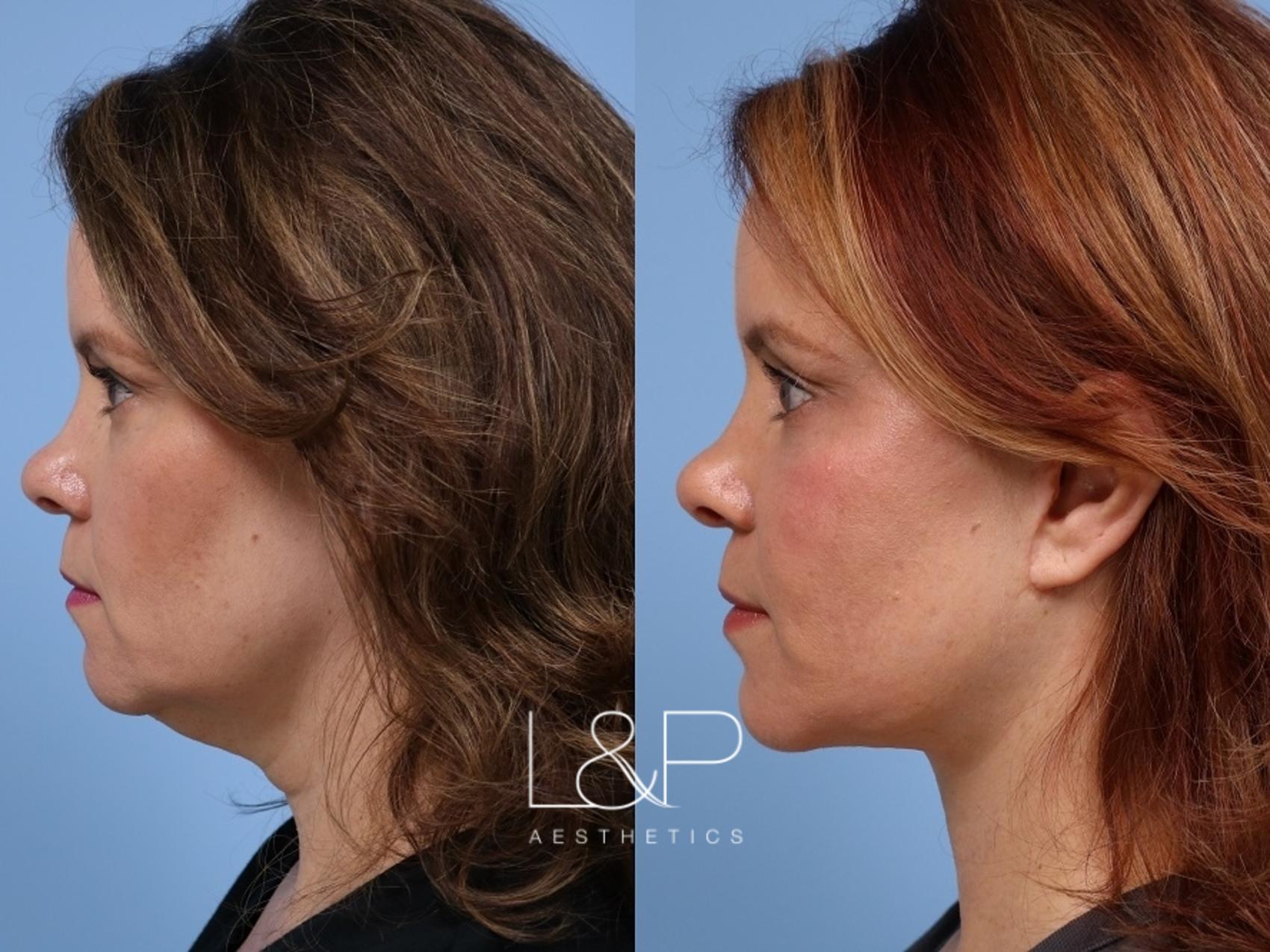 Facelift Neck Lift before and after treatment