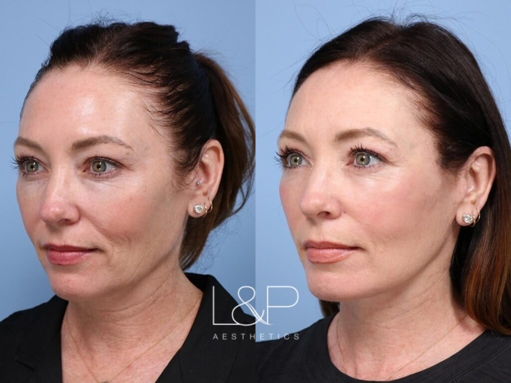 Facelift Neck Lift before and after treatment