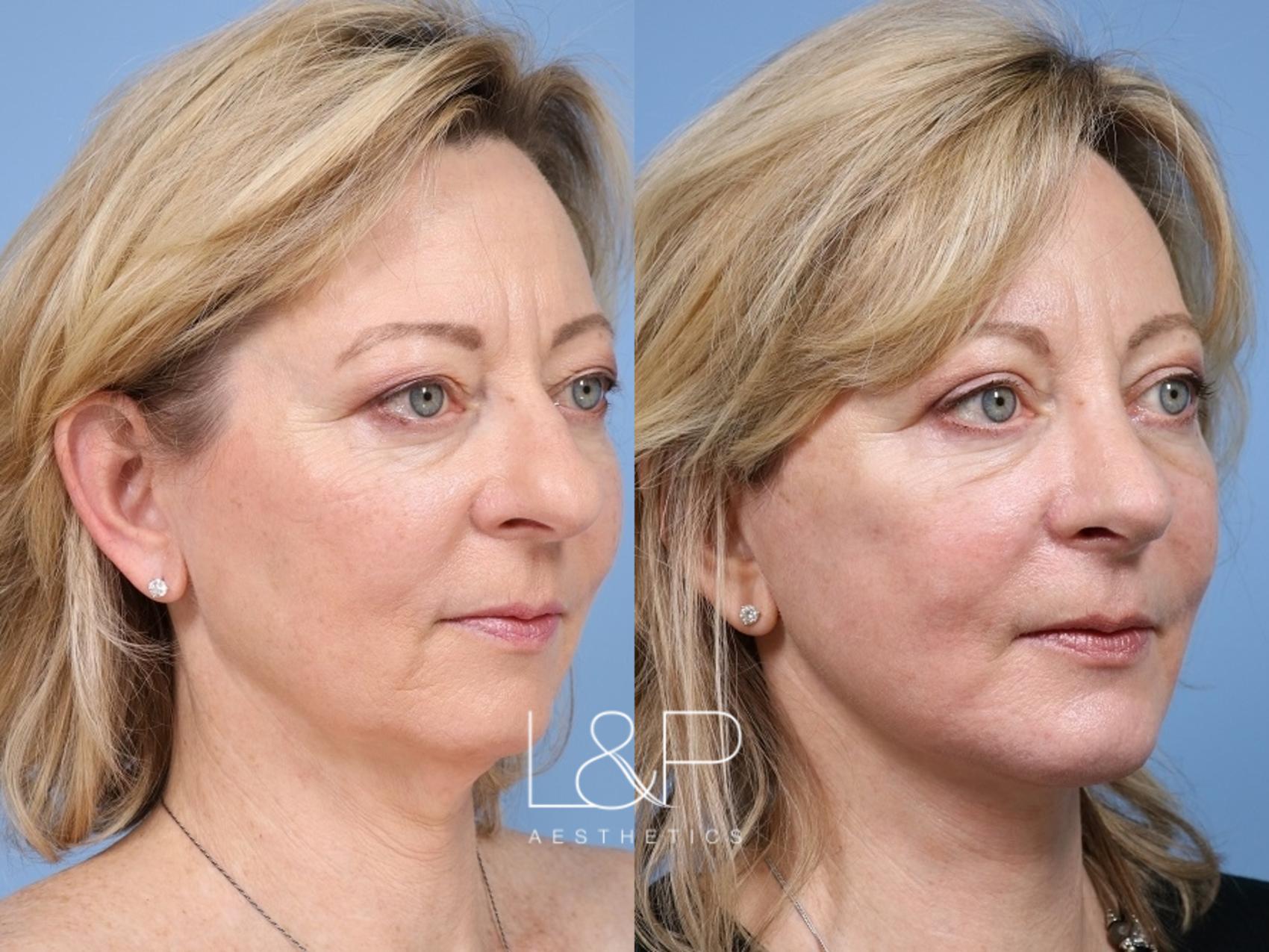 Facelift Neck Lift before and after treatment
