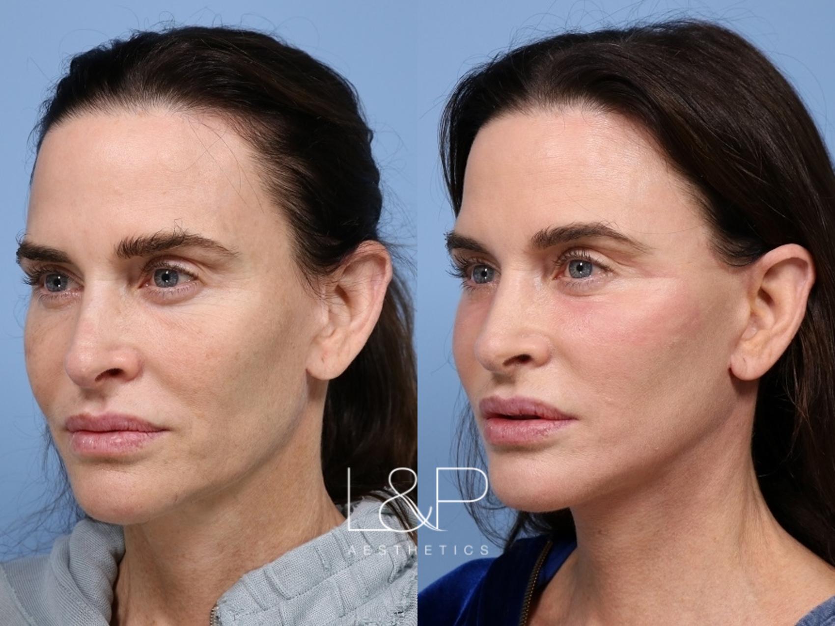 Facelift Neck Lift before and after treatment