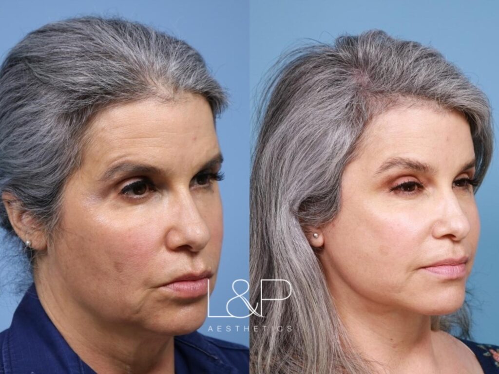 Facelift Neck Lift before and after treatment