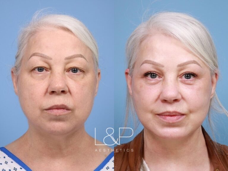 Facelift Neck Lift before and after treatment