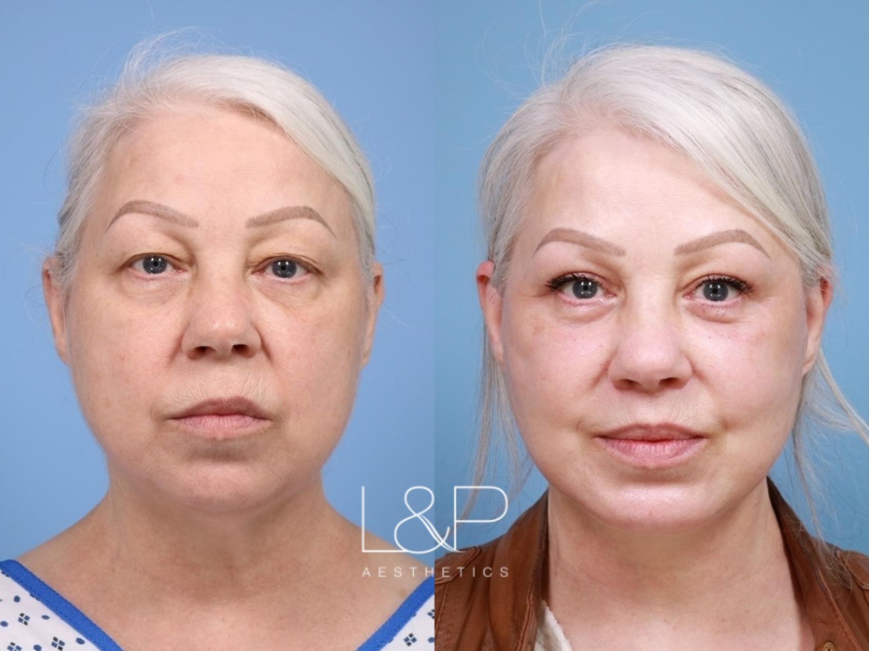 Facelift Neck Lift before and after treatment