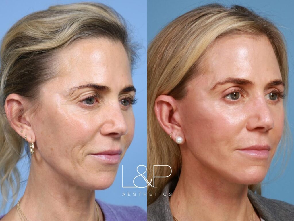 Facelift Neck Lift before and after treatment