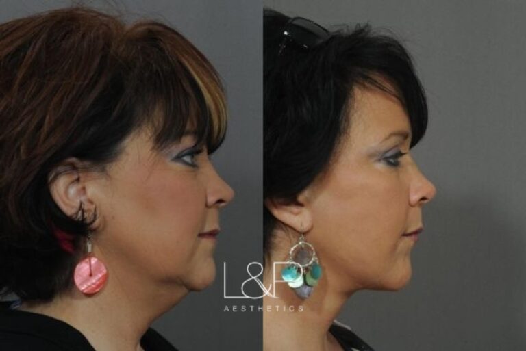 Facelift Neck Lift before and after treatment in Los Gatos, California