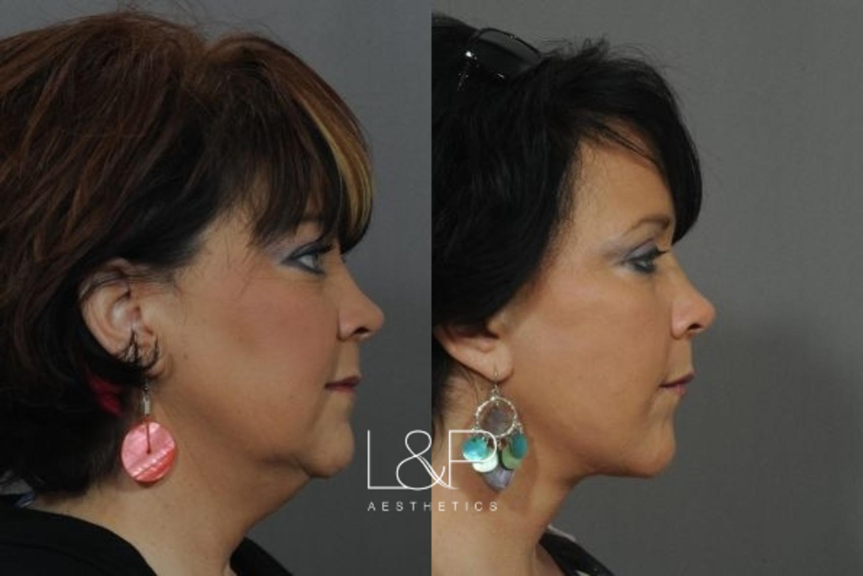 Facelift Neck Lift before and after treatment in Los Gatos, California