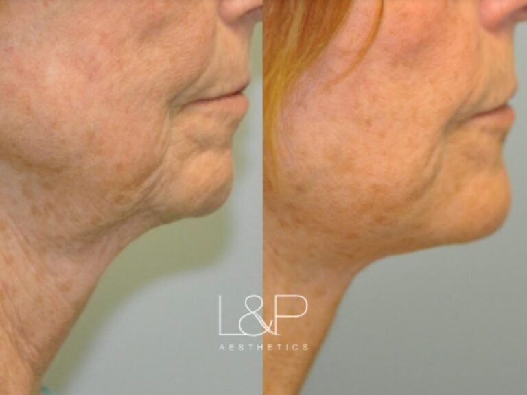 Facelift Neck Lift before and after treatment in Palo Alto, California