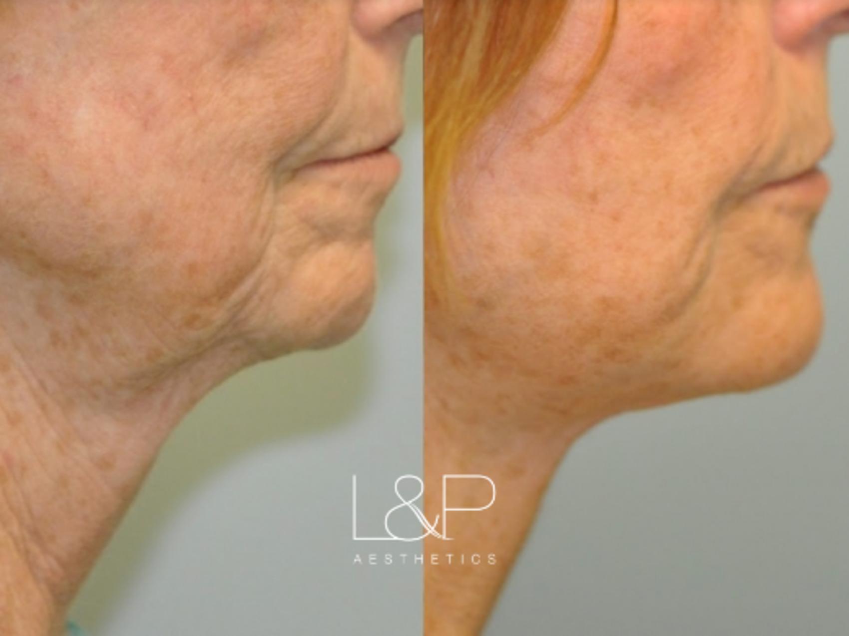 Facelift Neck Lift before and after treatment in Palo Alto, California