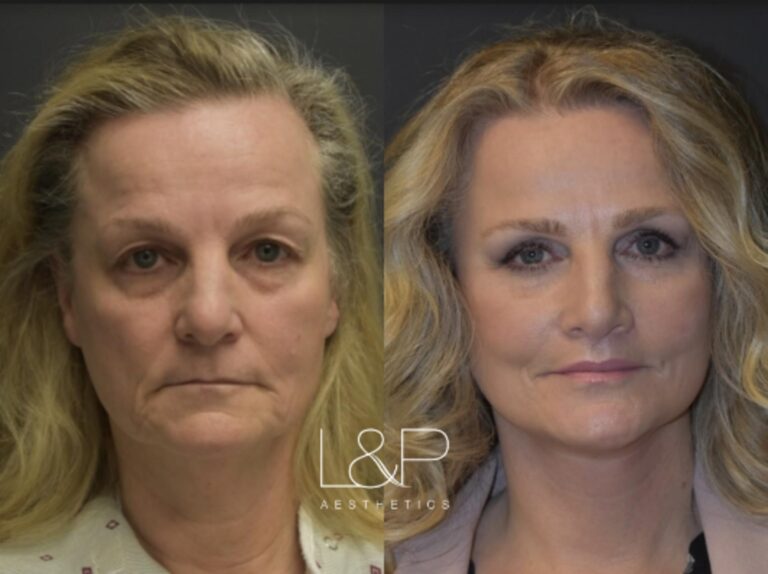 Facelift Neck Lift before and after treatment in California