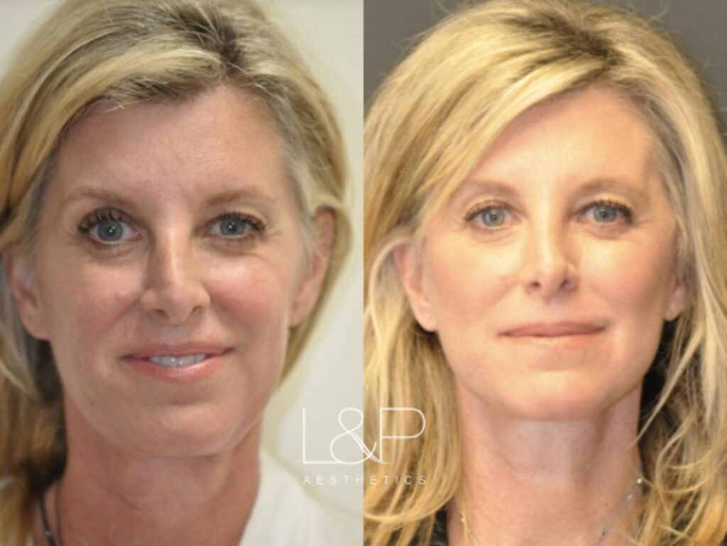 Facelift Neck Lift before and after treatment in Los Gatos, California