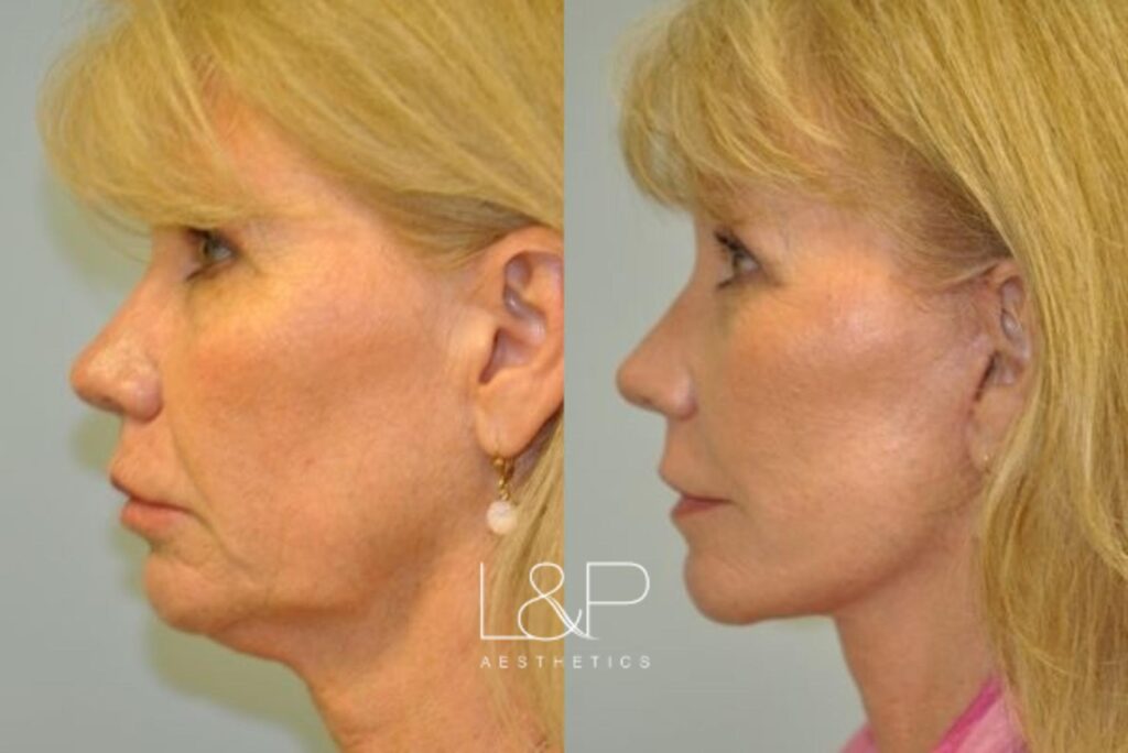 Facelift Neck Lift before and after treatment in CA