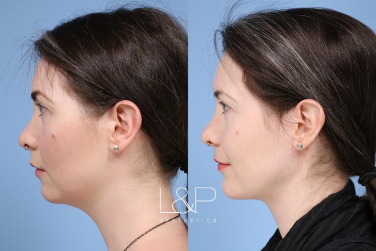 Facetite / Accutite Before and after treatment