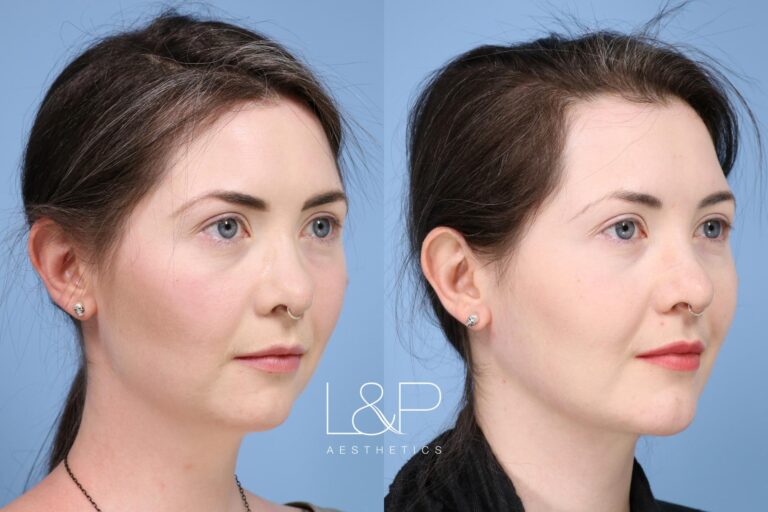 Facetite / Accutite Before and after treatment
