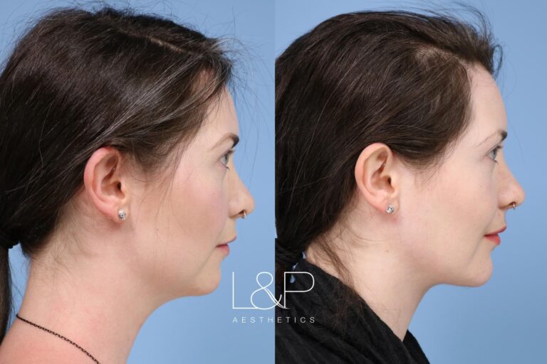 Facetite / Accutite Before and after treatment