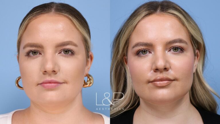 Facetite / Accutite Before and after treatment